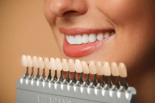 Sorriso perfetto con trattamenti di estetica dentale — Studio Odontoiatrico Dott. Enrico Martini